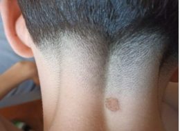 Bruciato con una sigaretta al collo  mentre è in fila fuori dal locale:  «Mio figlio è rimasto traumatizzato»