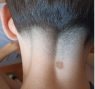 Bruciato con una sigaretta al collo <BR> mentre è in fila fuori dal locale: <BR> «Mio figlio è rimasto traumatizzato»